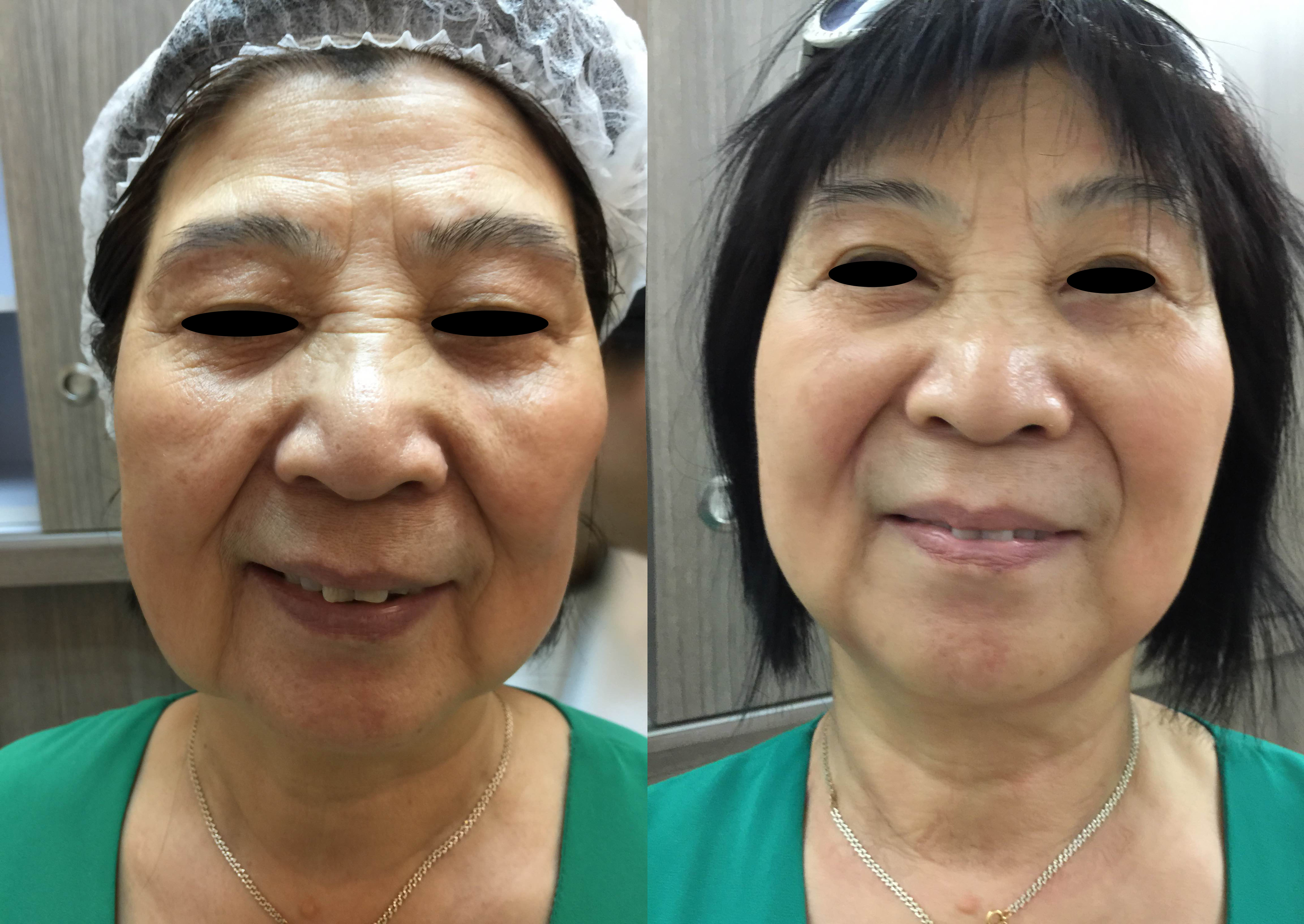 Natural Face Lift Treatment, Microneedling for Scars