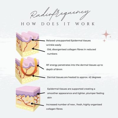 RF Natural Facial - how it works