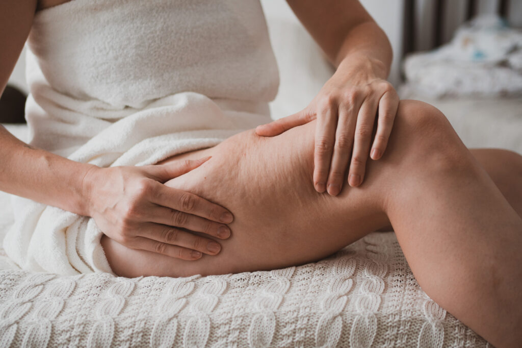 cellulite treatment beverly hills
